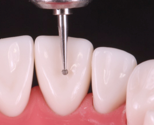 Axis dental fraises dentaires